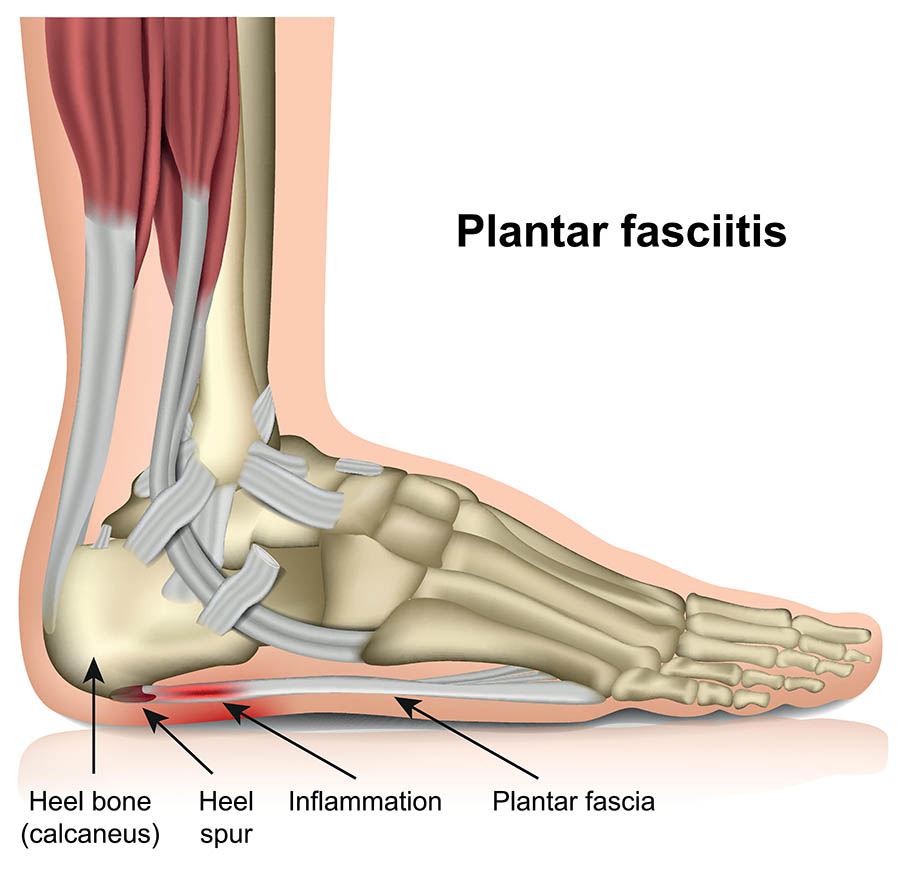 Uric Acid Plantar Fasciitis Treatment What Causes My Heel To Hurt